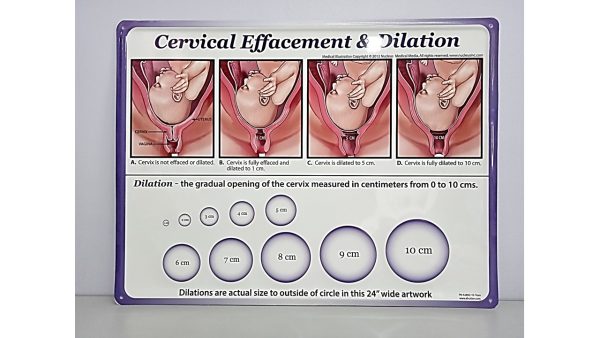 Dilation and Cervical Effacement Board